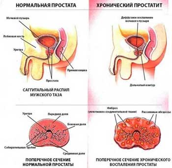 Что такое простатит