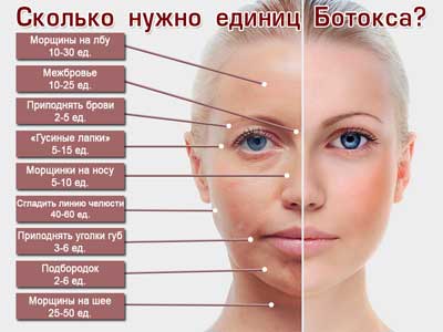 инъекции ботокса