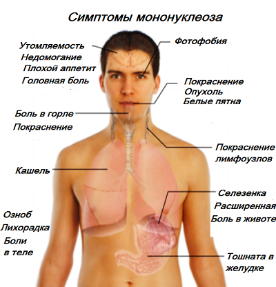 Инфекционный мононуклеоз