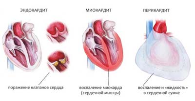 Миокардит