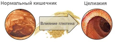 Целиакия у детей