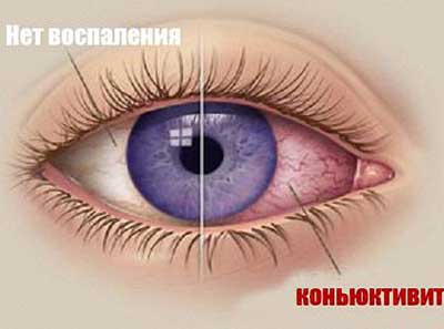 Конъюнктивит
