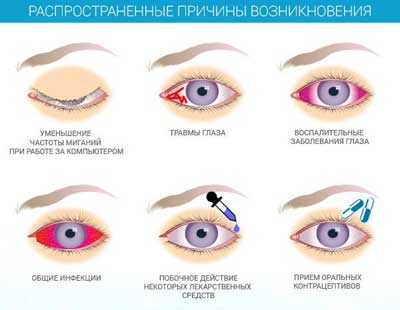 Конъюнктивит