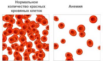 Хроническая усталость