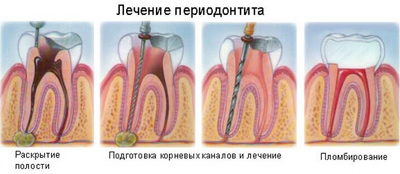 Острый периодонтит: лечение, симптомы, клинические признаки