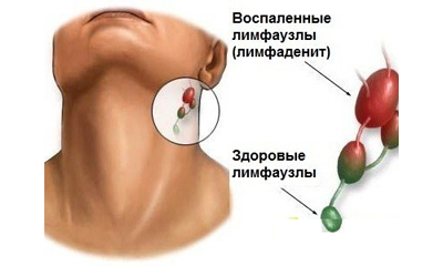 Лимфаденит: описание, причины, симптомы