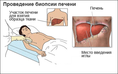 Биопсия печени: цель, описание, риски