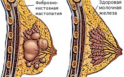 Заболевания молочной железы