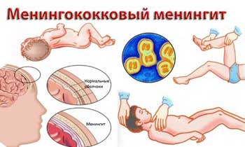 симптомы менингита