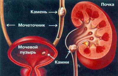 Как лечить мочекаменную болезнь