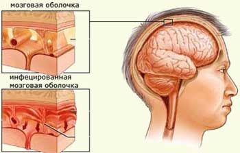 симптомы менингита