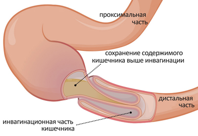 Кишечная непроходимость у детей