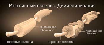 Что такое рассеянный склероз
