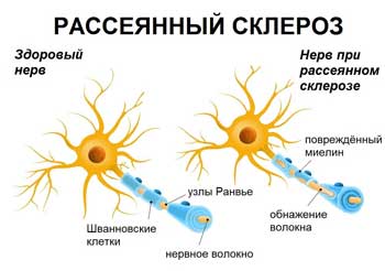 Рассеянный склероз