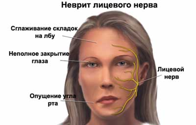 Паралич Белла