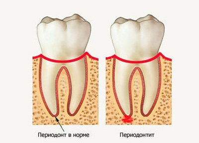 Острый периодонтит: лечение, симптомы, клинические признаки