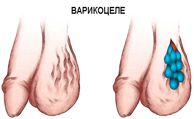 варикоцеле