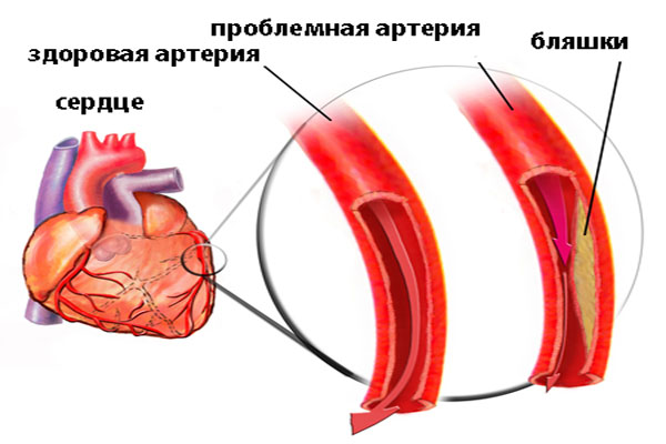 диагностика стенокардии