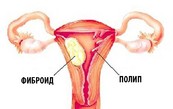 полипы в матке