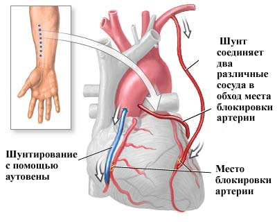 Коронарное шунтирование сосудов сердца