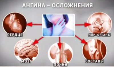 Ревматическая лихорадка (ревматизм)