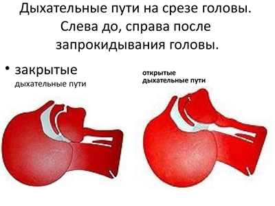 сердечно-легочная реанимация