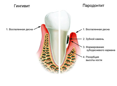 Лечение десен