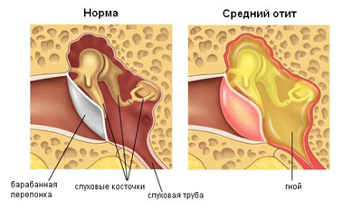 Перфорация барабанной перепонки
