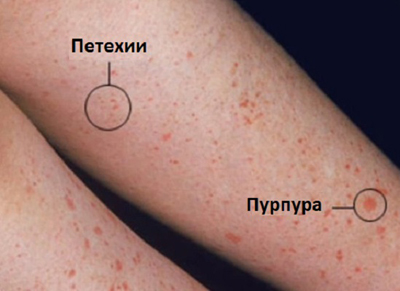 аллергическая пурпура и ее последствия