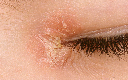 Симптомы сухой кожи вокруг глаз