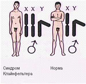 синдром Клайнфельтера