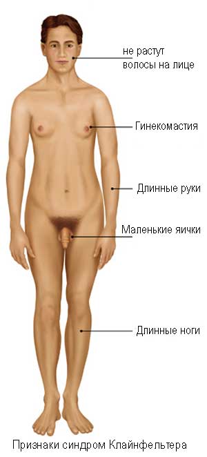 синдром Клайнфельтера