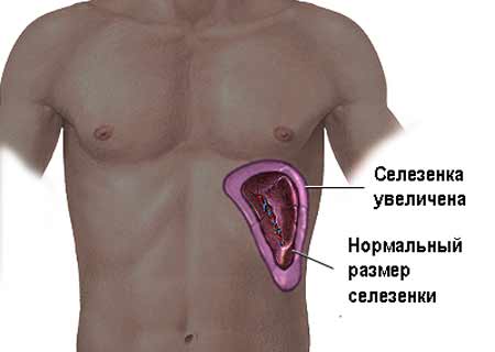Селезенка увеличена