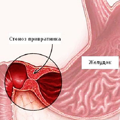Пилоростеноз: диагностика, лечение