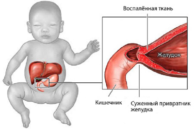 Детская хирургия