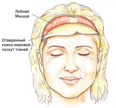 Классический лифтинг лба