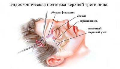 эндоскопическая подтяжка лба