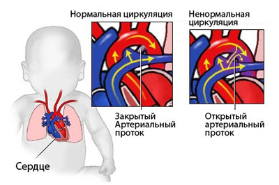 Кардиохирургия врожденных пороков