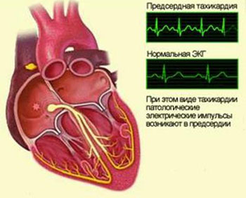Что такое тахикардия