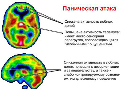 Агорафобия: описание, симптомы, лечение