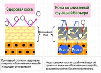 Контактный дерматит