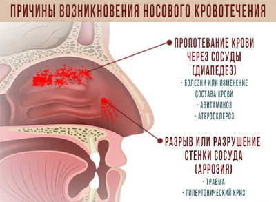 Что делать при кровотечении из носа