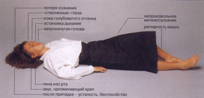 Противоэпилептические препараты