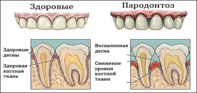 Лечение десен