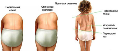 Сколиоз: природа, диагностика, лечение