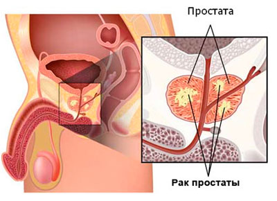 Рак простаты. Выбор метода лечения
