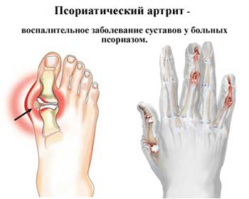 Псориатический артрит