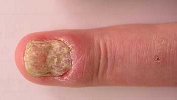 http://moskovskaya-medicina.ru/sovety/griby-shiitake-recepty-lechenie.html