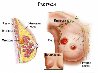 Заболевания молочной железы