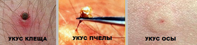 Аллергия на укусы насекомых: симптомы, лечение